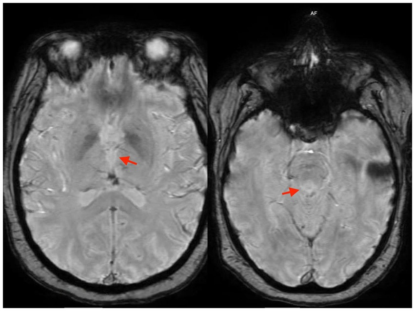 Case Report: Wernicke’s encephalopathy induced by prolonged fasting due to apparent psychogenic dysphagia