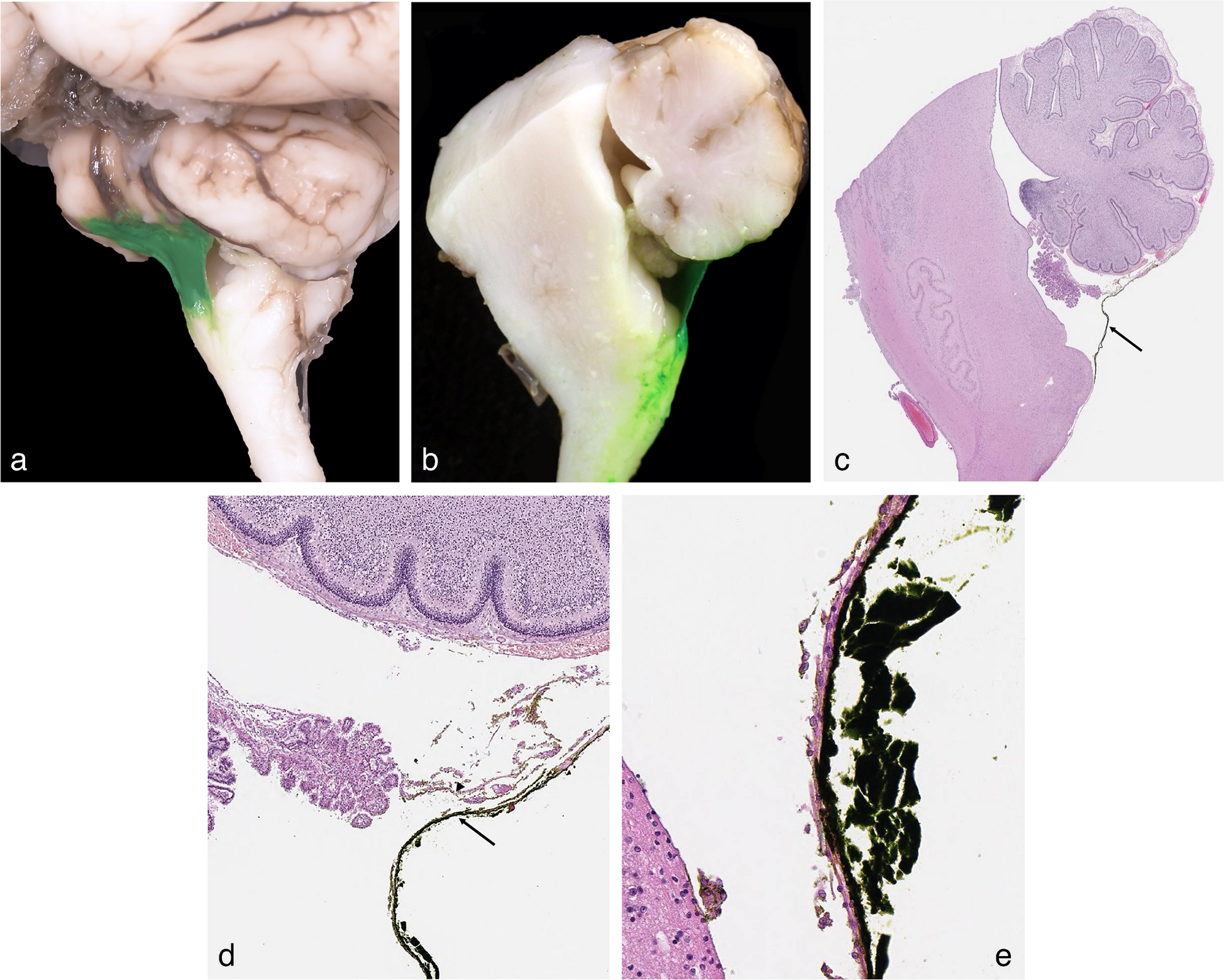 The fetal taenia–tela choroidea complex: a radiologic–pathologic correlation from normal anatomy to Dandy-Walker malformation