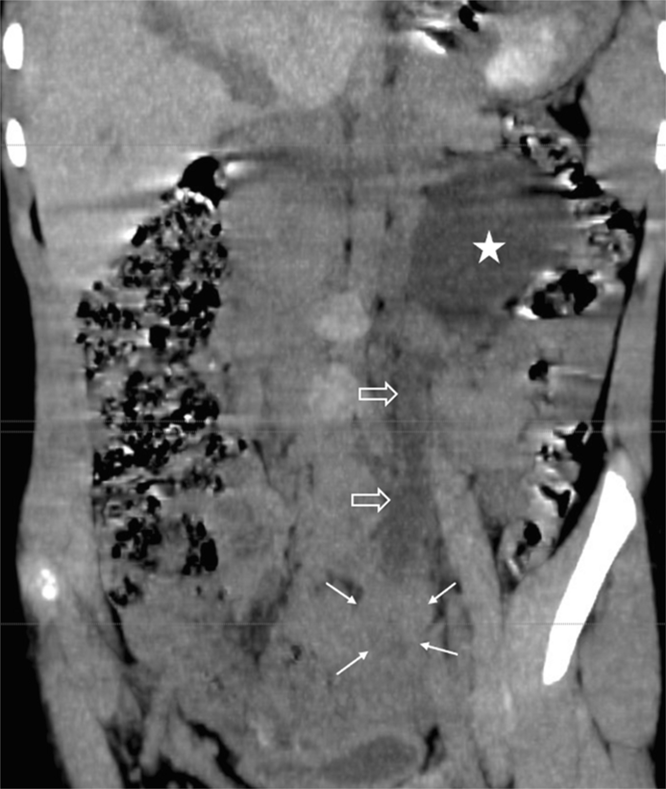 Pediatric IgG4-related inflammatory pseudotumor of the ureter: a unique entity with ultrasound, computed tomography, and magnetic resonance imaging findings