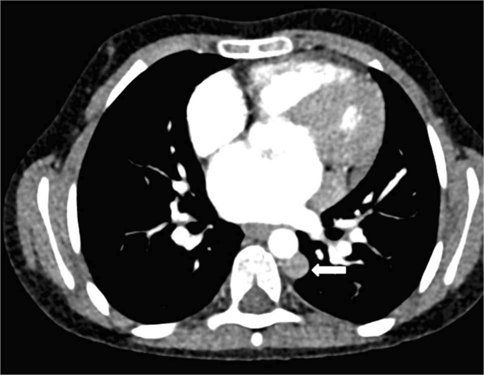 Silent complexity: a rare combination of polysplenia, cleft palate, retroaortic renal vein, and dorsal pancreatic agenesis