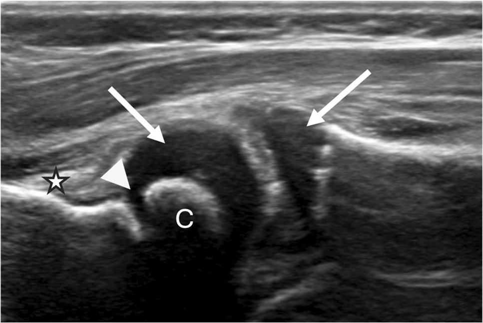 Pediatric musculoskeletal ultrasound of the elbow: a pictorial review
