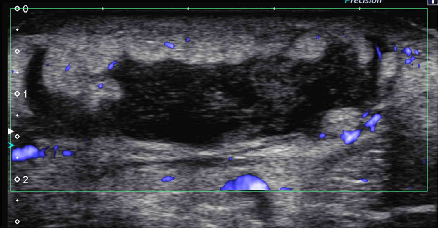 Imaging of acute musculoskeletal infections in children and their differential diagnoses