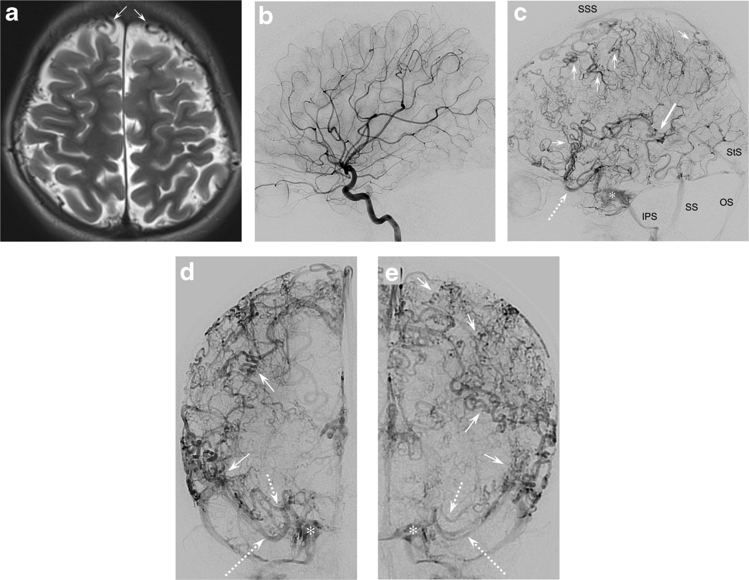 Non-restrictive cerebral venous dysgenesis in an 11-year-old girl: a case report