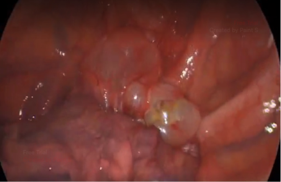 Video-assisted thoracoscopic blebotomy for spontaneous pneumothorax treatment using the no-knife endoscopic stapler