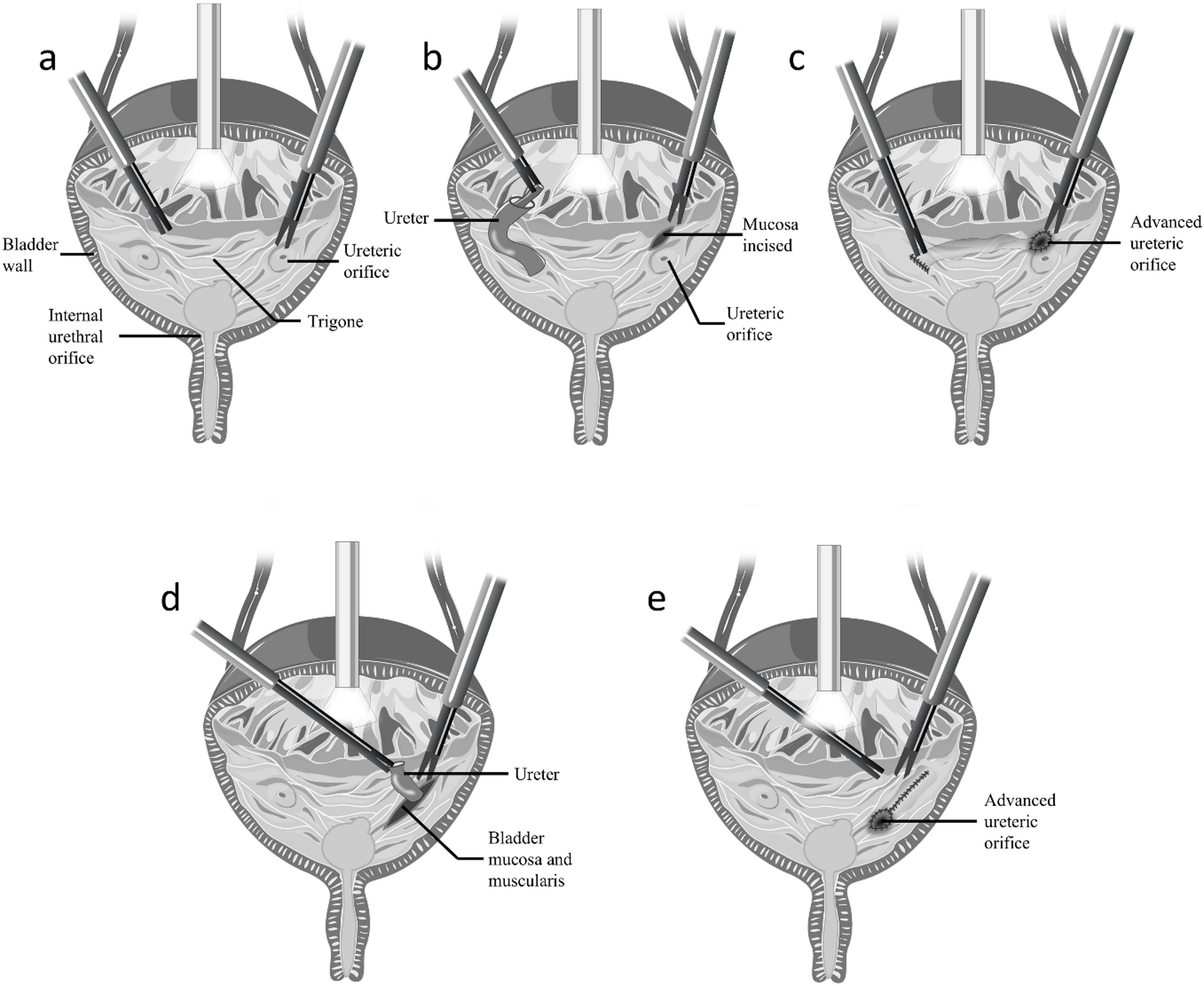 Long-term efficacy and learning curves of Cohen and modified Glenn-Anderson pneumovesicoscopic ureteral reimplantation for primary obstructive megaureter: a retrospective cohort study with meta-analysis