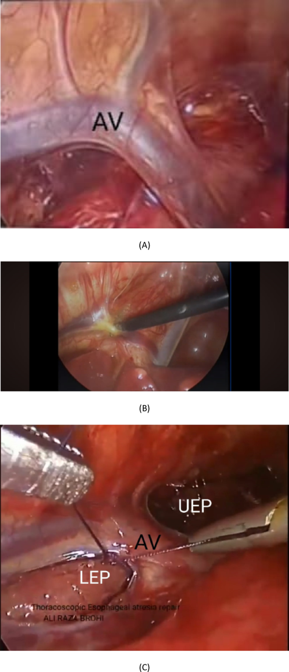 Evaluation of surgical outcomes of thoracoscopic esophageal atresia repair with and without preservation of azygos vein: a retrospective cohort study