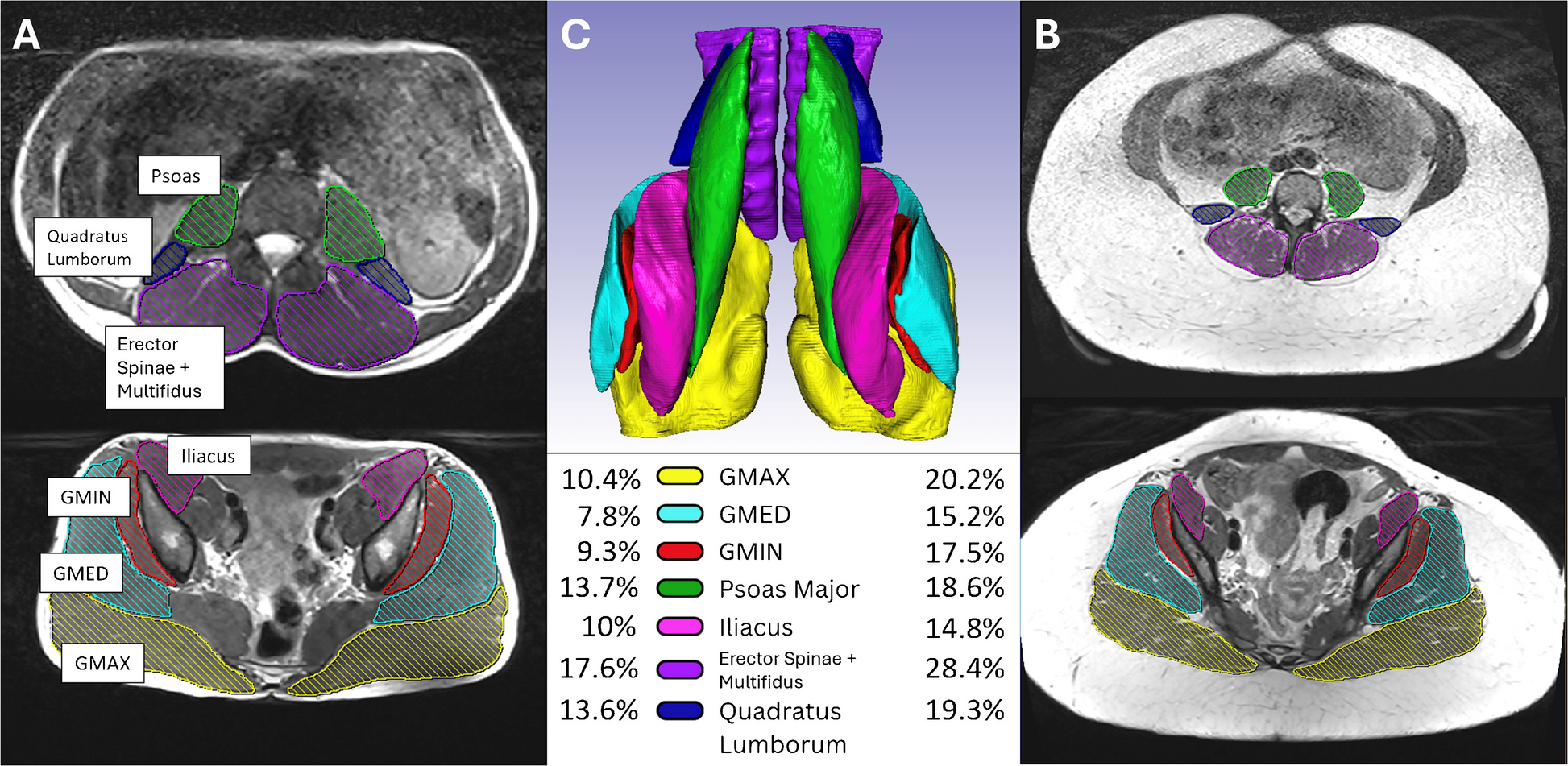 Quantitative MRI of core muscles at different activity levels: muscle-specific metrics and composite core fat fraction and lean-volume scores