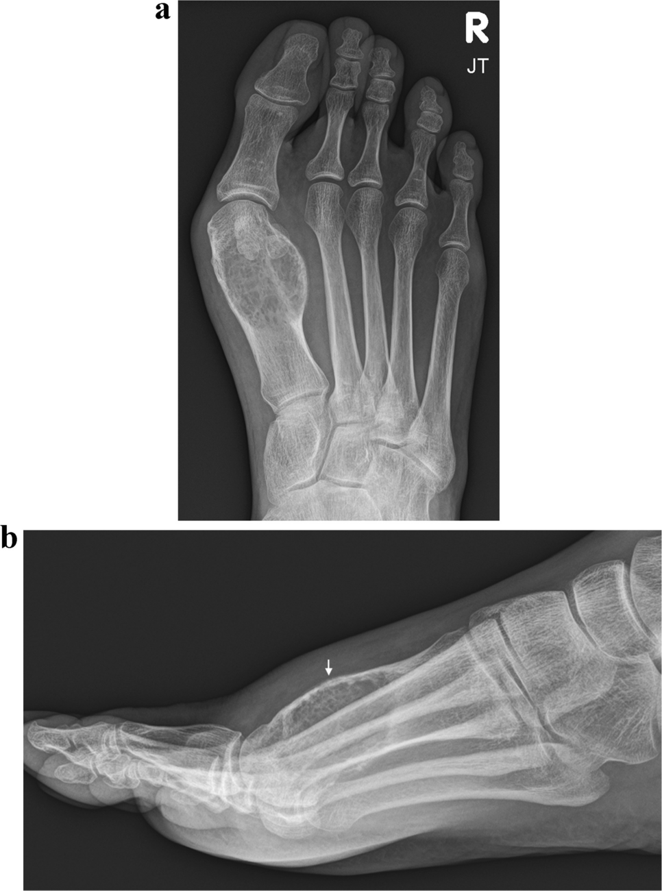 Primary malignant aneurysmal bone cyst of the metatarsal with  fusion: expanding the clinicopathologic spectrum of malignant USP6 translocated neoplasms