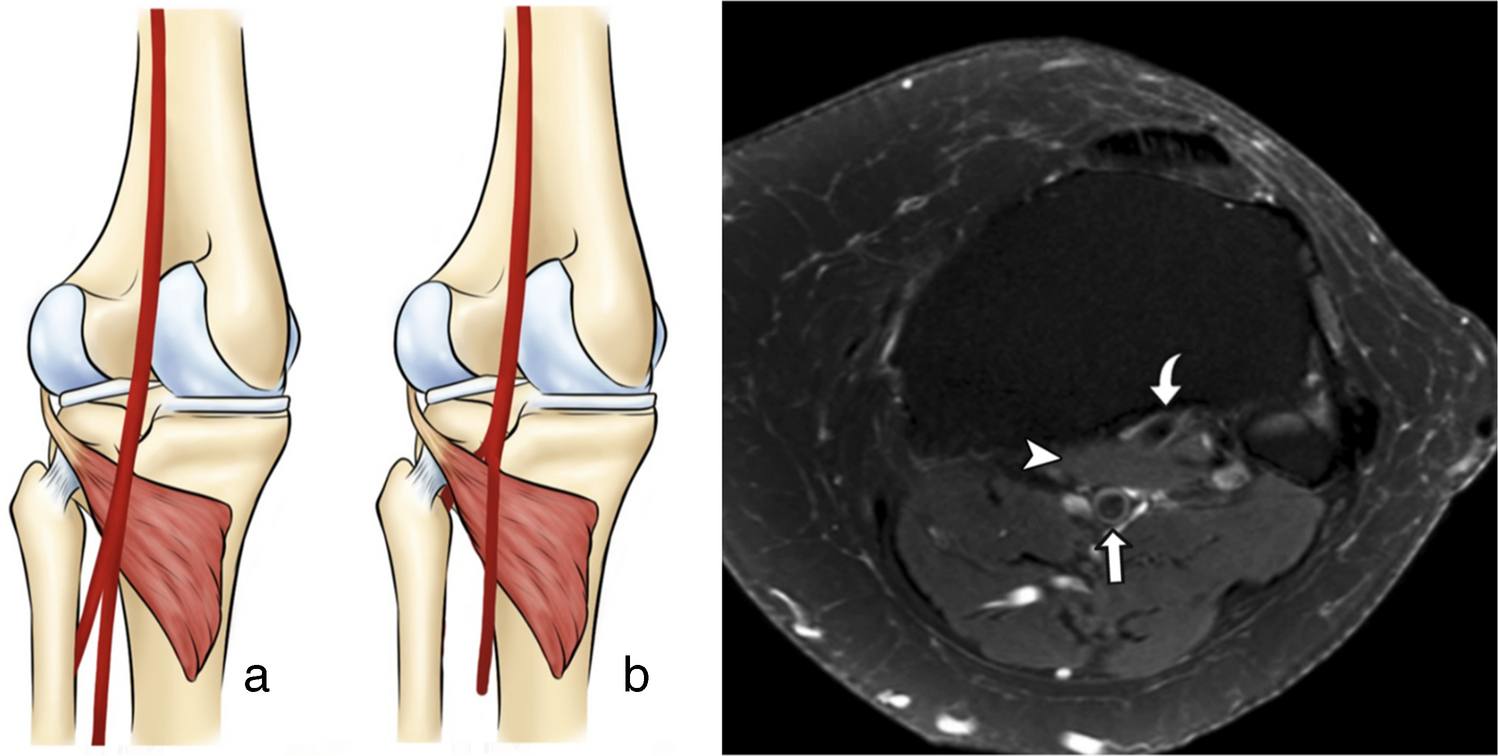 Deep learning-based identification of aberrant anterior tibial artery on knee MRI: a brazilian multicenter study