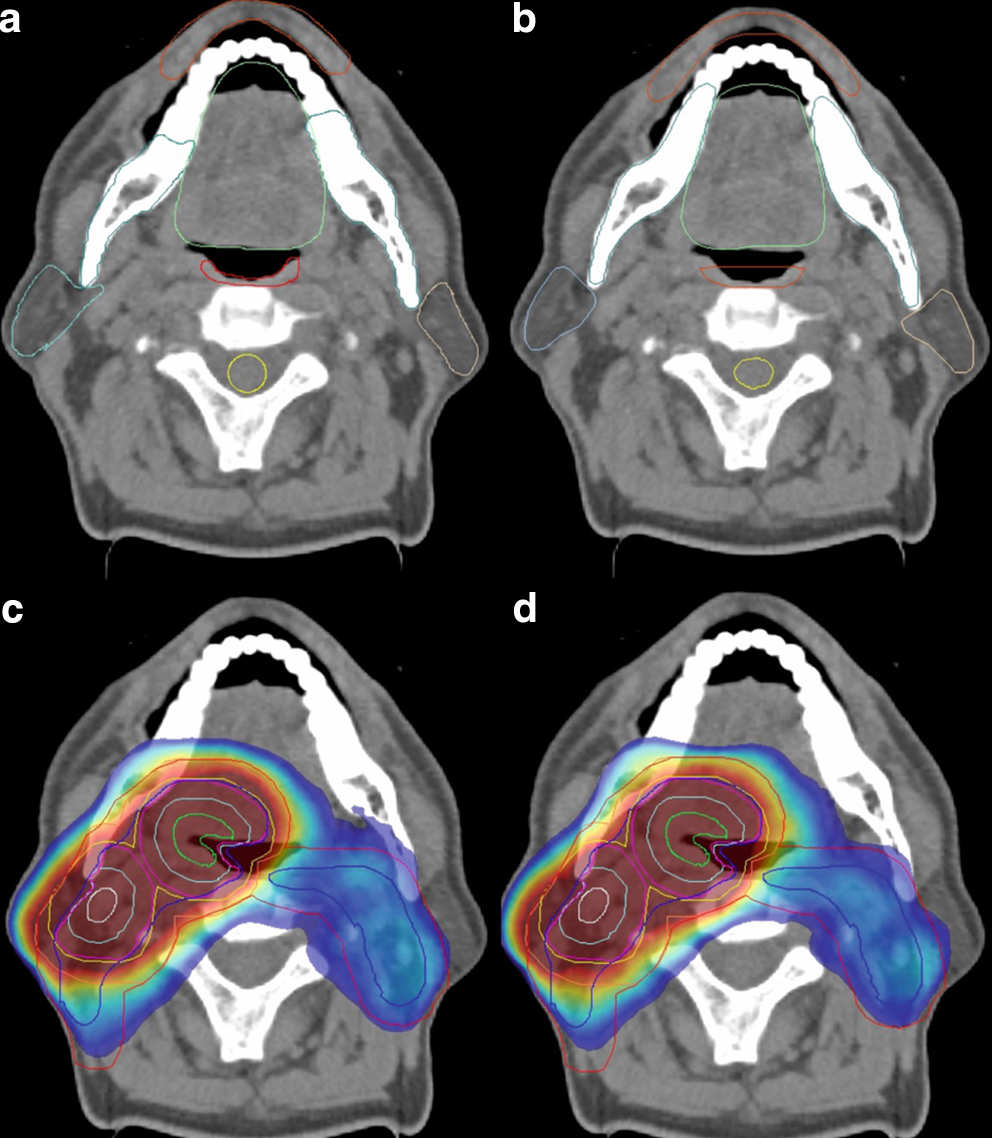 Inverse treatment planning using deep learning-based organs at risk in radiotherapy for head and neck cancer: a prospective planning study