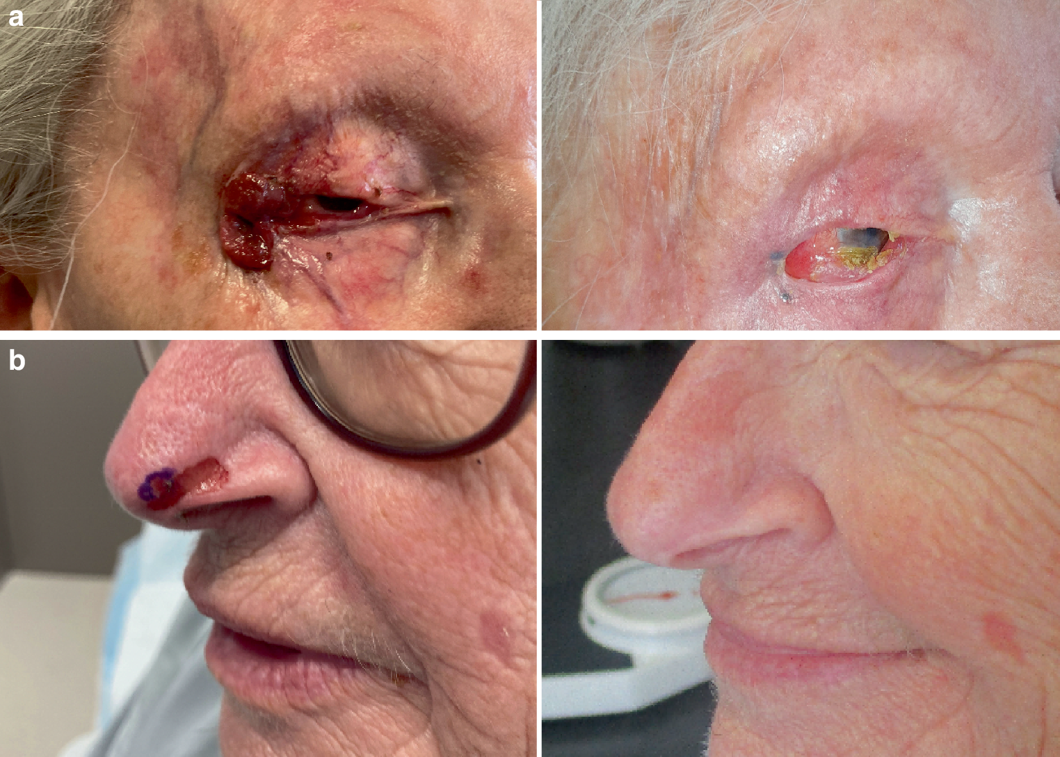 Expert opinion: radiotherapy for basal cell carcinoma