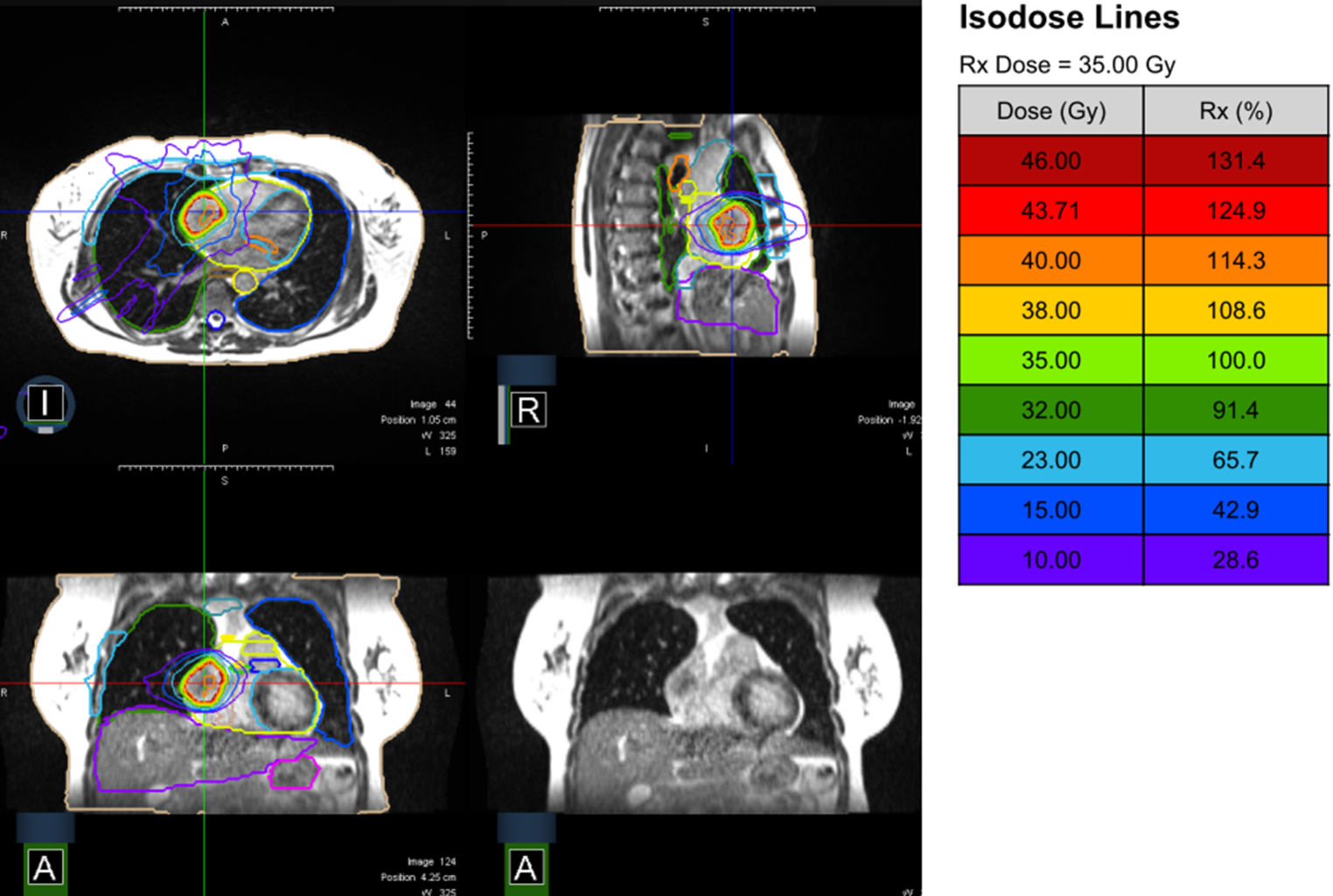 Stereotactic heart ablative radiotherapy (SHARP): a prospective multicentric phase II trial