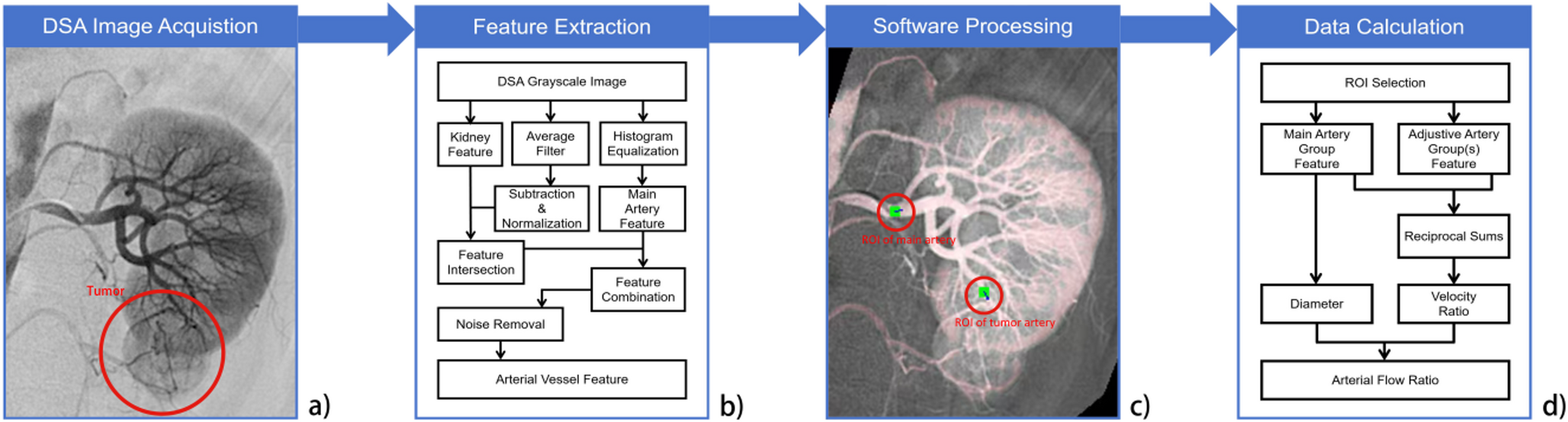 Using flow ratio of peritumoral artery/renal aorta from DSA imaging to predict high-risk clear cell renal cell carcinoma