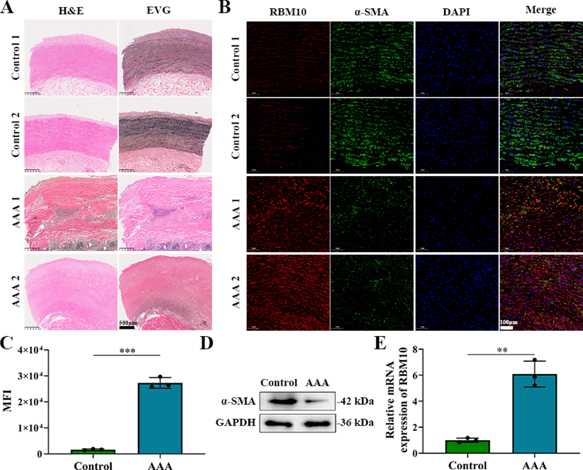 RNA-binding motif protein 10 accelerates abdominal aortic aneurysm formation by inducing smooth muscle cell apoptosis