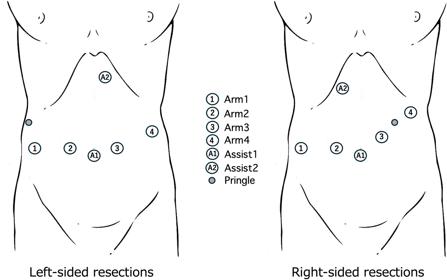 Surgeon-controlled robotic CUSA technique for liver parenchymal transection