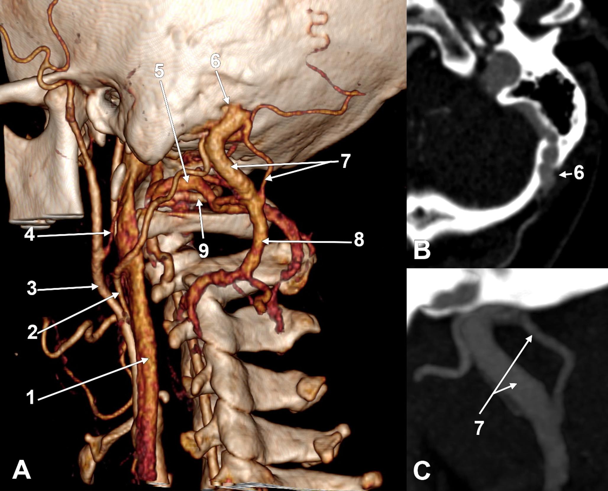 Fenestrated giant mastoid emissary vein, a novel finding