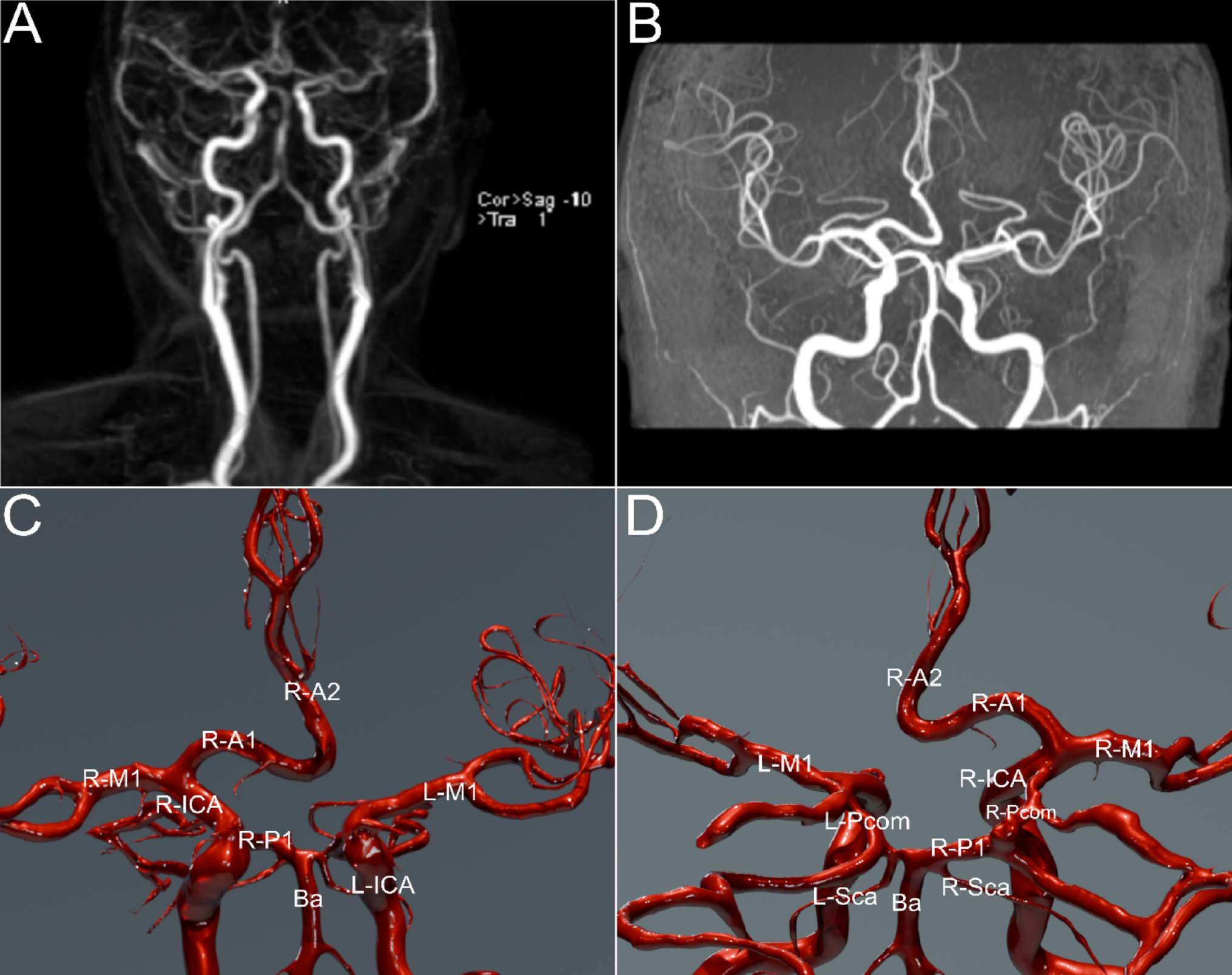 An unusual variant of the anterior cerebral and anterior communicating arterial system: anatomical description with clinical and radiological implications