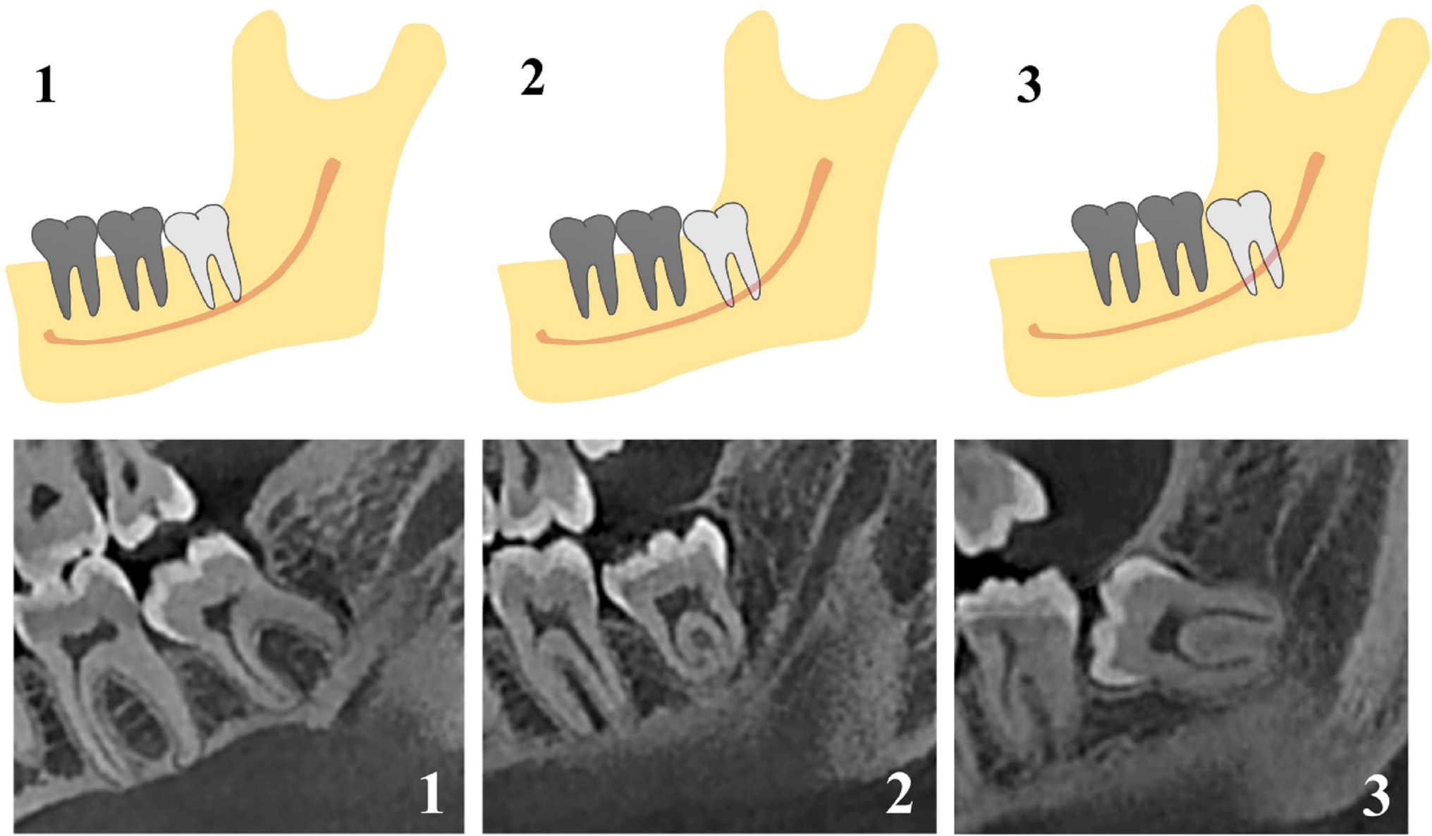 Evaluation of the relationship between the gonial angle and the pattern of the impacted mandibular third molar by cone beam computed tomography