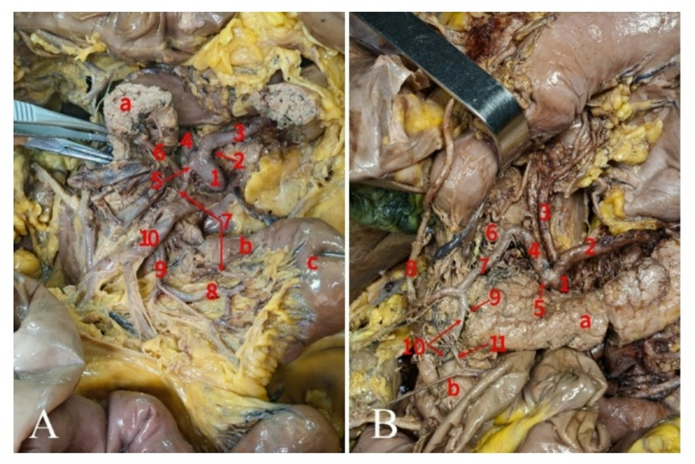 Anastomosis of the dorsal pancreatic artery and first jejunal artery forming a pancreaticojejunal arcade: a clinically significant Bühler-type celiac–mesenteric collateral