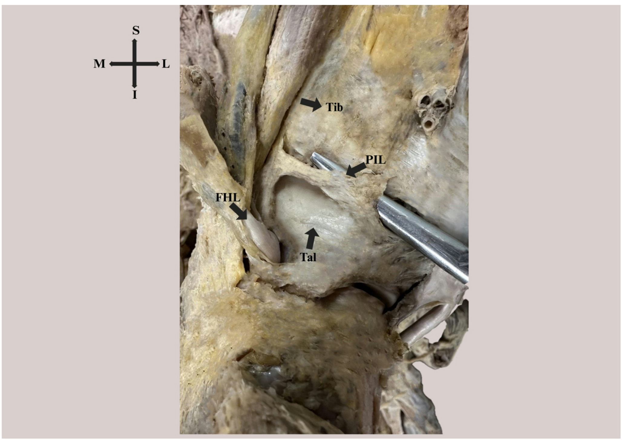 Posterior interosseous ligament of the ankle: current evidence and knowledge gaps