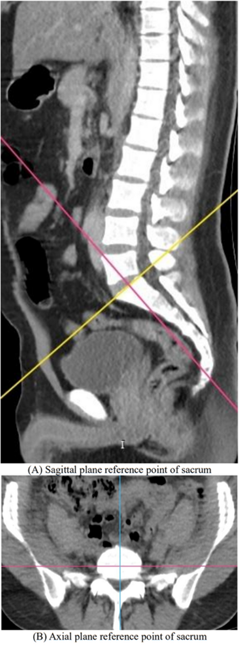 Sex estimation from sacral anatomy in Turkish adults: a machine learning–based analysis