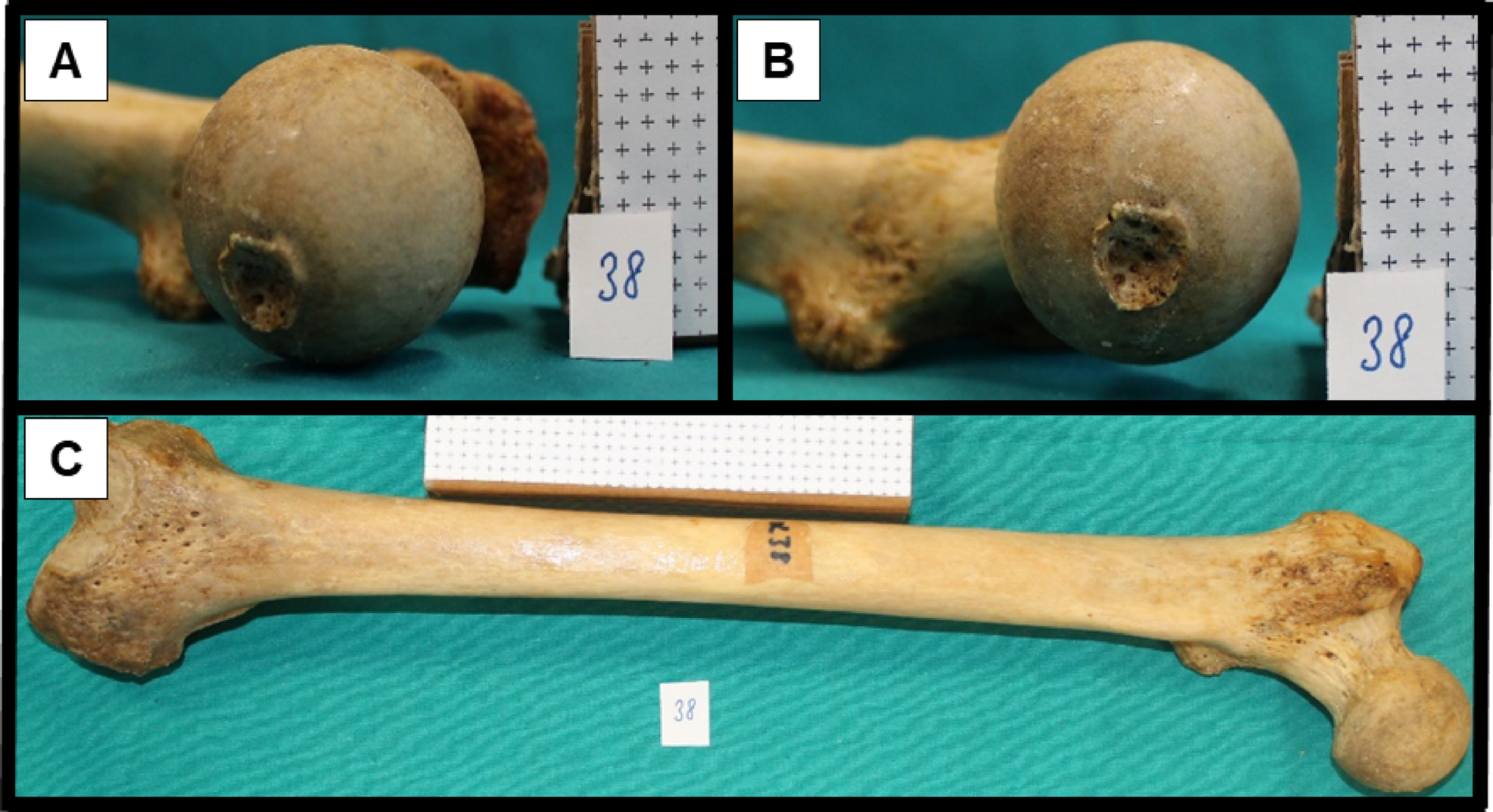 The fovea capitis femoris as a dynamic surgical landmark: morphometric associations with the femoral inclination angle