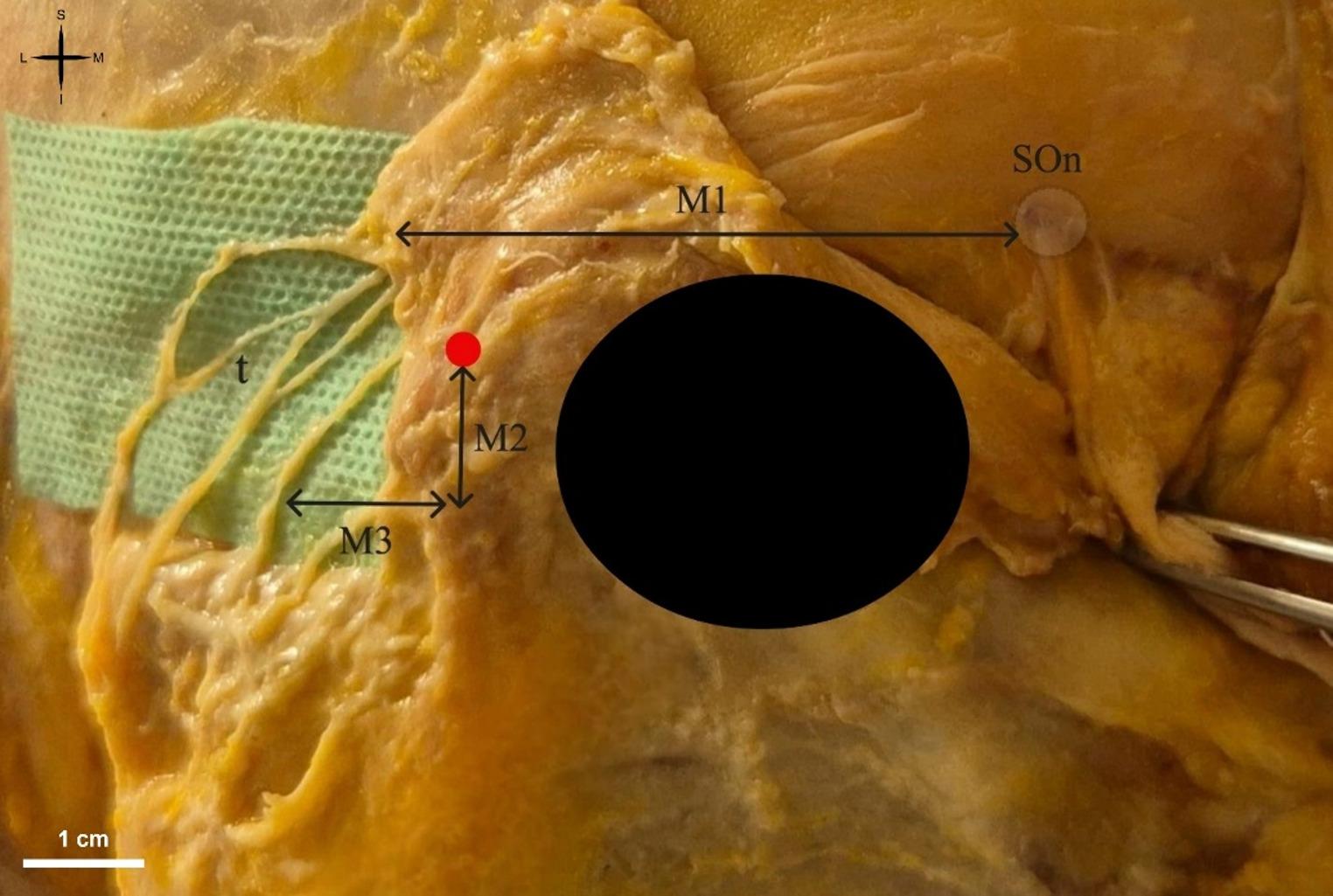 Anatomical validation of safe zones for facial nerve preservation in supraorbital keyhole approach: a cadaveric study