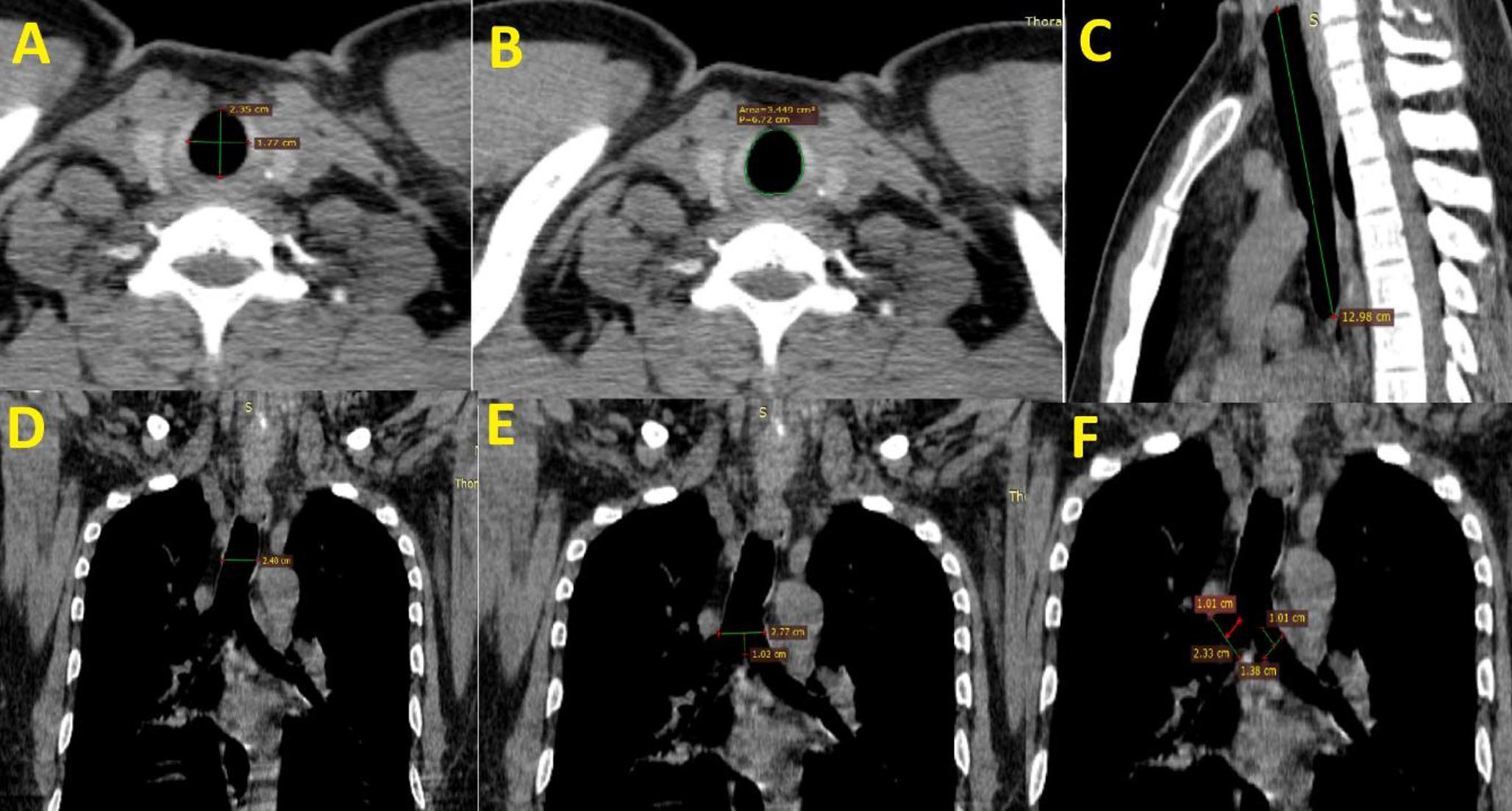Tracheal morphometry using computed tomography in North Indian adults without any respiratory illness and its correlation with spirometry indices