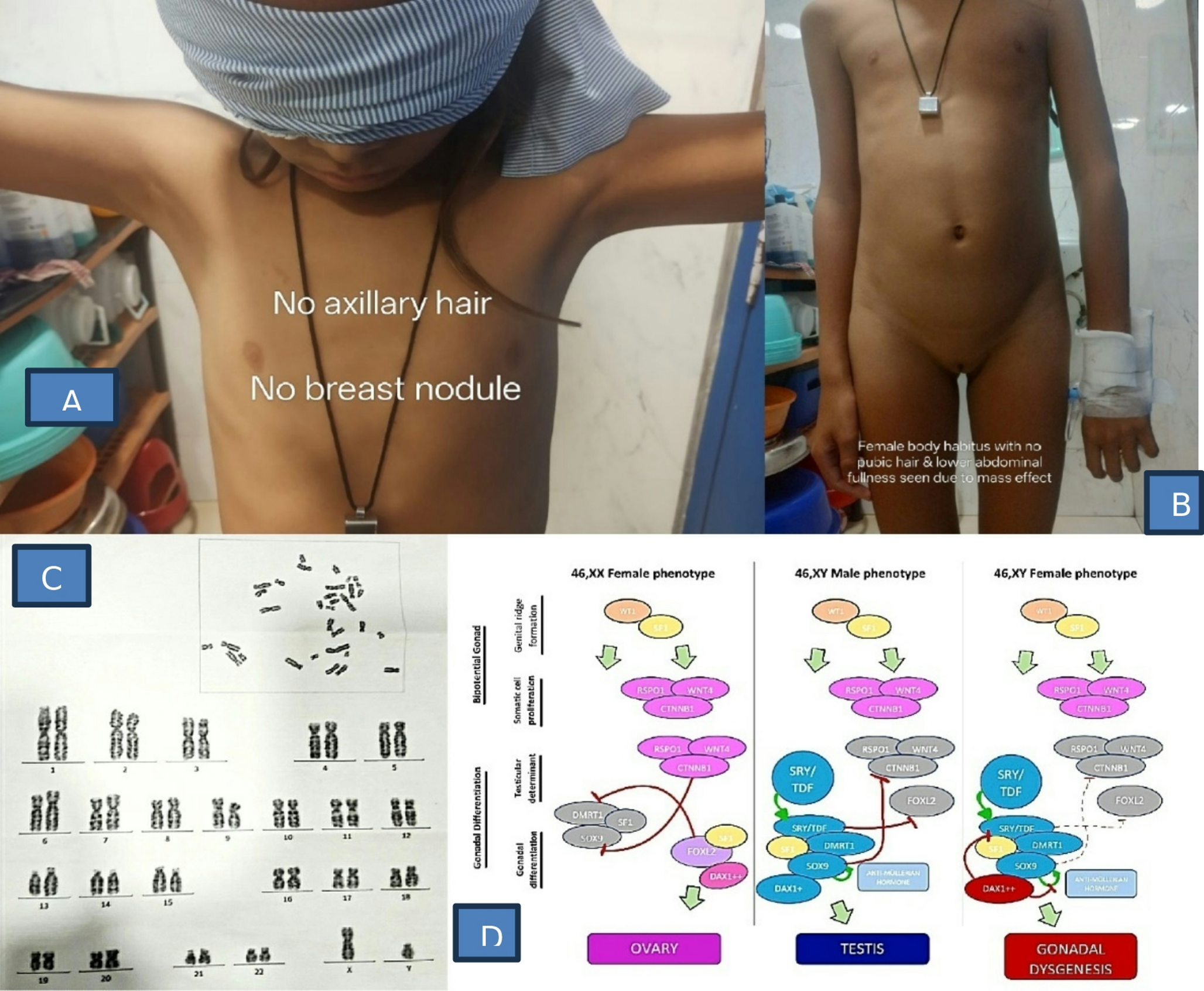 A Rare Case of Ovarian Dysgerminoma in an 11 Year Old with Swyer Syndrome-A Case Report