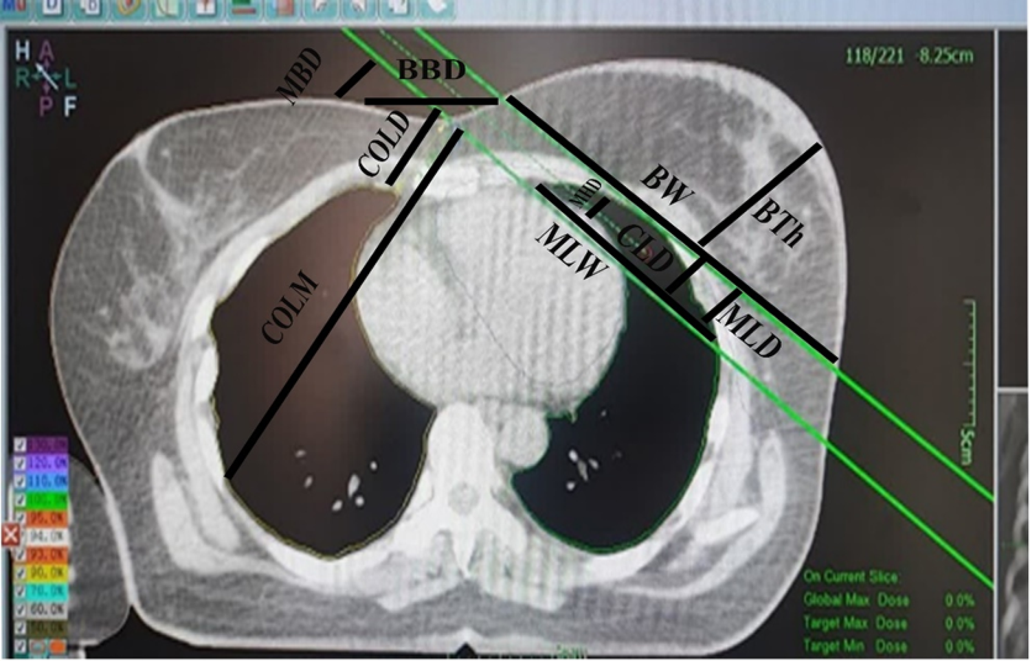 Evaluation of Machine Learning Algorithms in Predicting Cardiac and Pulmonary Doses for Breast Cancer Patients Undergoing Radiation Therapy: A Multi-Label Classification Approach with Feature Selection
