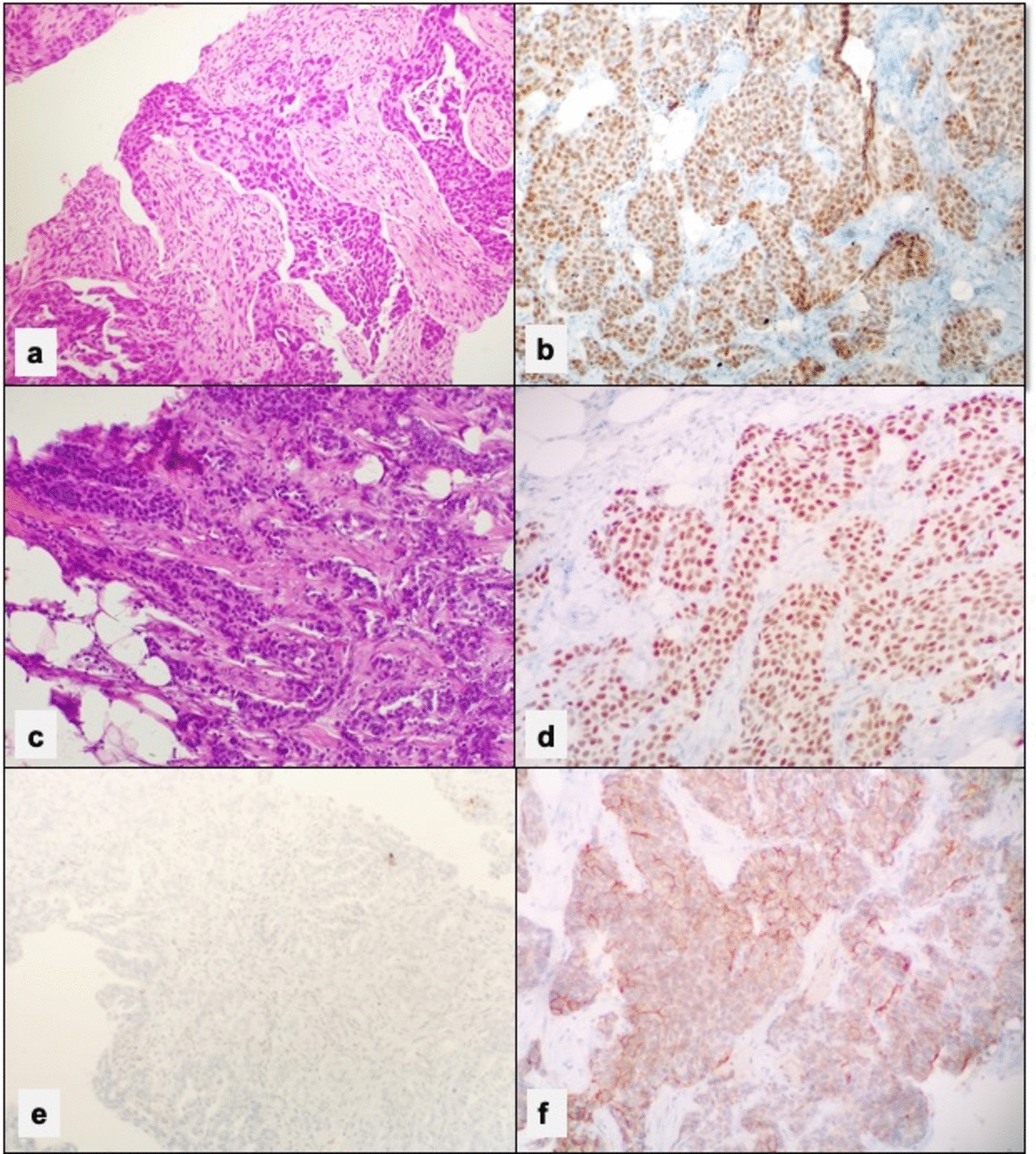 Therapeutic Challenges in Management of Synchronous Cancer of Cervix and Breast: Case Report and Review of Literature