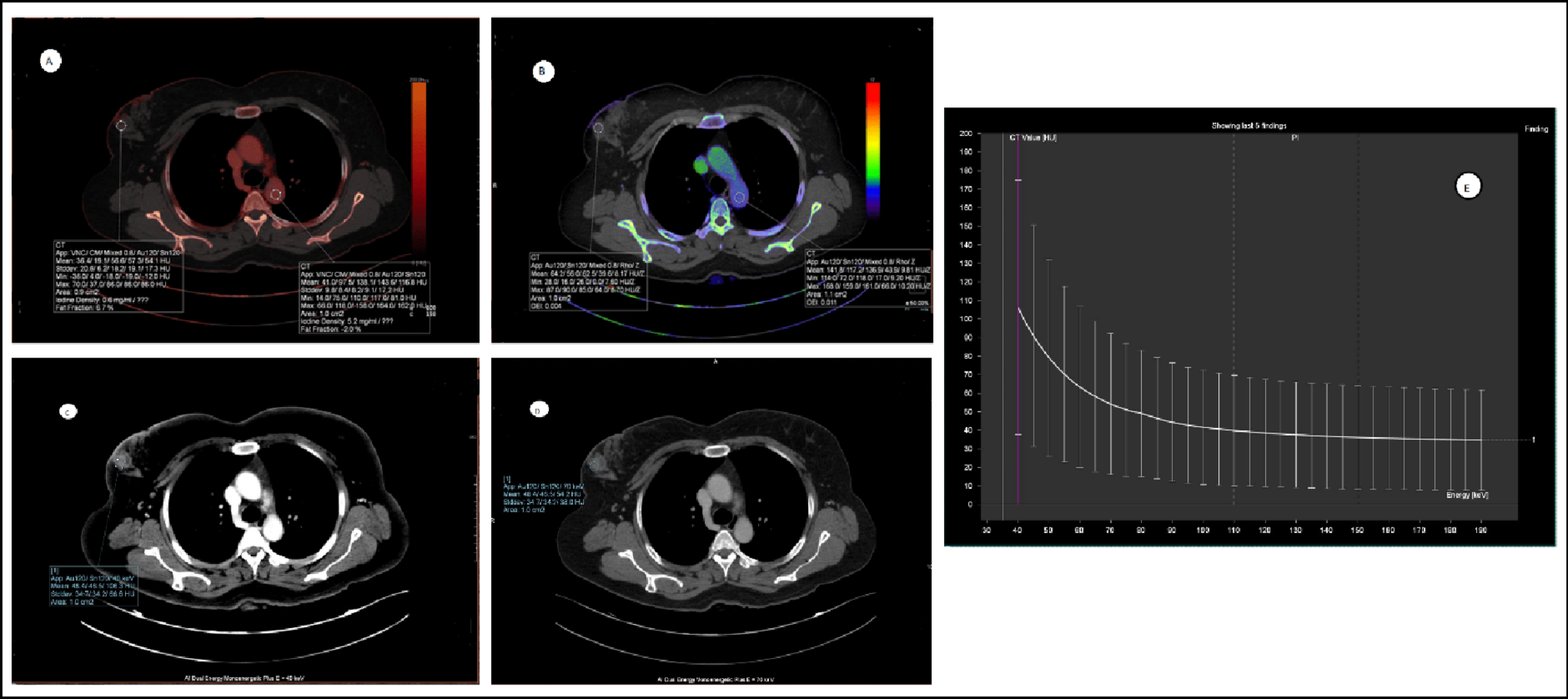 The Clinical Utility of Dual Energy Computed Tomography Quantitative Parameters in Evaluating Immunohistochemical (IHC) Biomarkers - Estrogen Receptor (ER), Progesterone Receptor (PR) And HER 2 (Herceptin 2 Receptor) in Invasive Breast Cancer: A Prospective Study