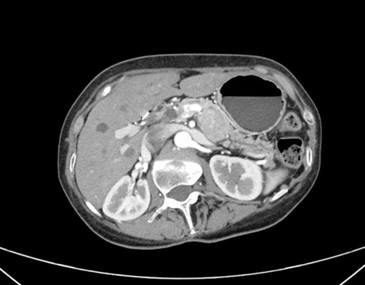 Fluorescence-guided lymphadenectomy using intralesional indocyanine green during laparoscopic distal pancreatectomy for pancreatic neuroendocrine tumor