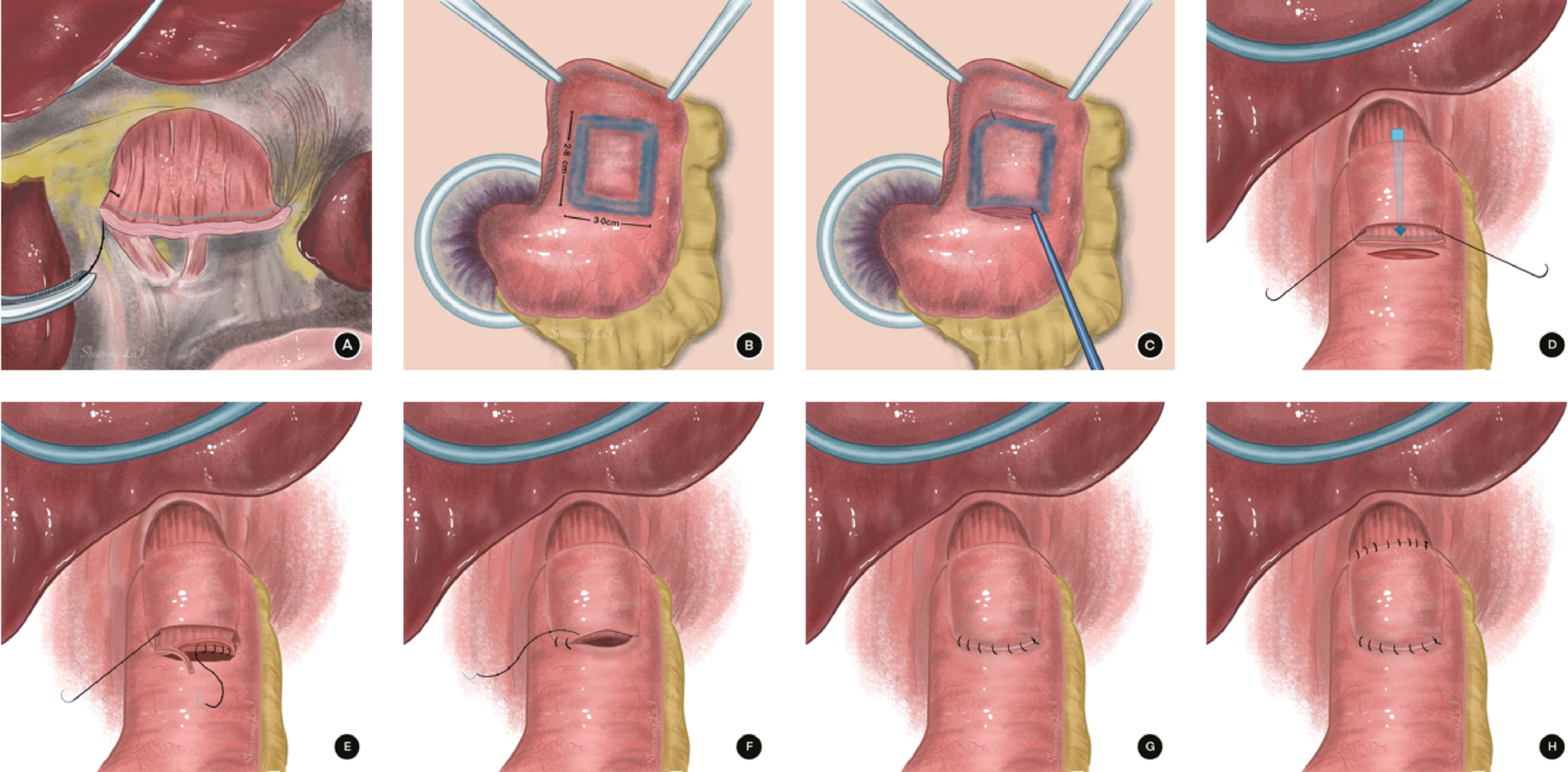 The tunnel-like flap technique for esophagogastrostomy in laparoscopic proximal gastrectomy: a comparative study on operative efficiency and early outcomes