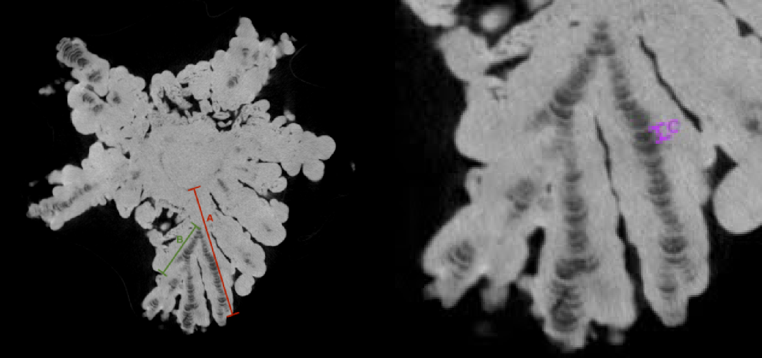 The anatomy of a jackstone: a novel morphometric analysis of a rare urinary calculus