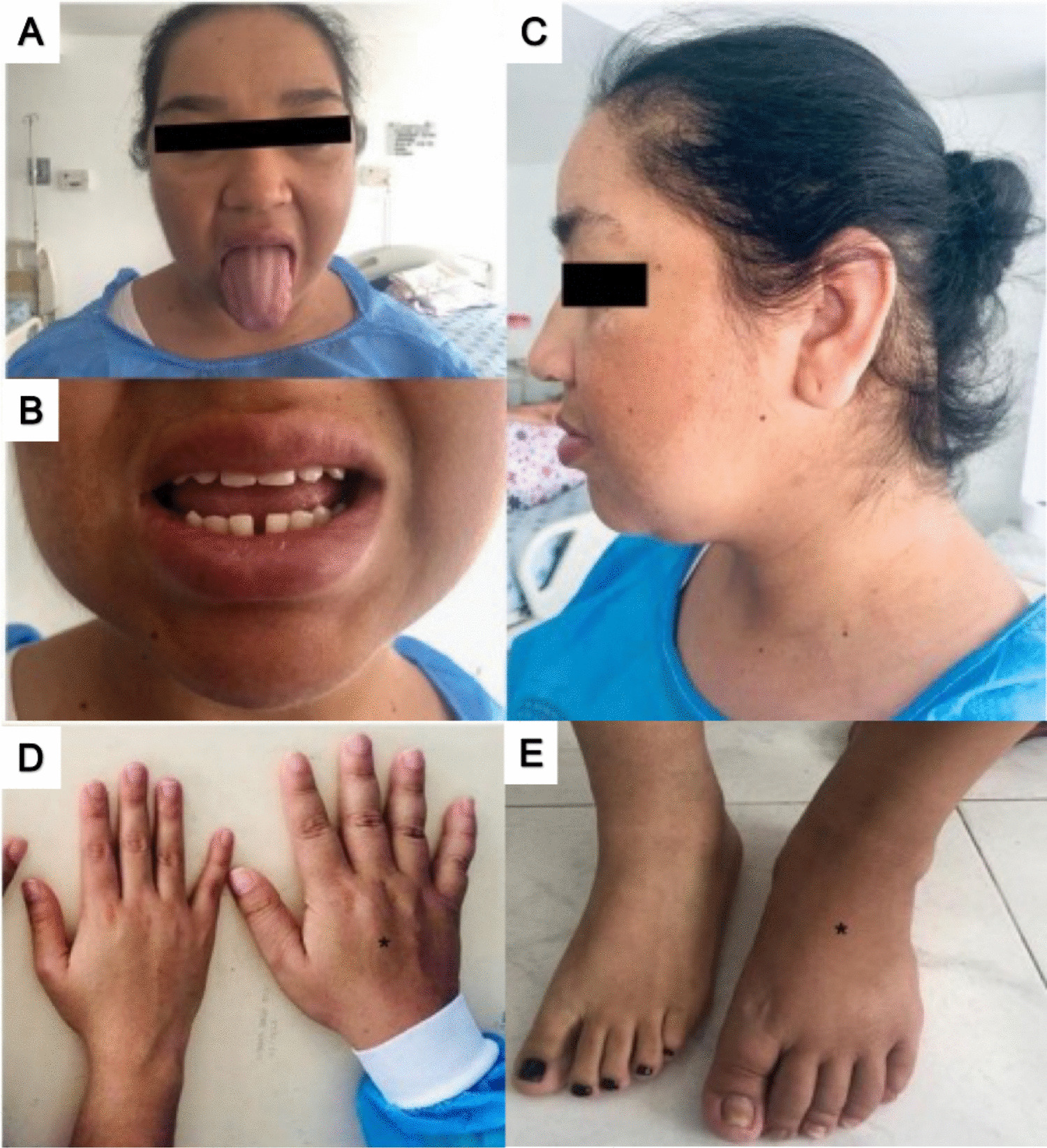 An Unusual Presentation of Severe Primary Hypothyroidism with Pseudoacromegaly and Pituitary Hyperplasia: Case Report
