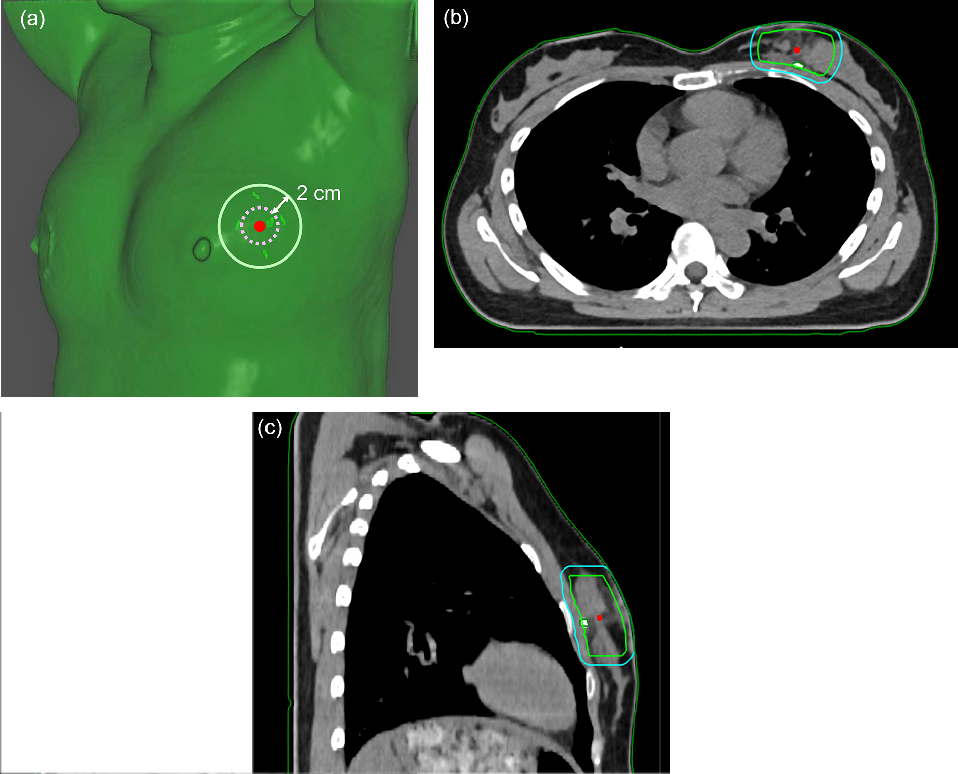 Early outcomes of accelerated partial breast irradiation and dosimetric comparison of volumetric modulated arc therapy and three-dimensional conformal radiotherapy