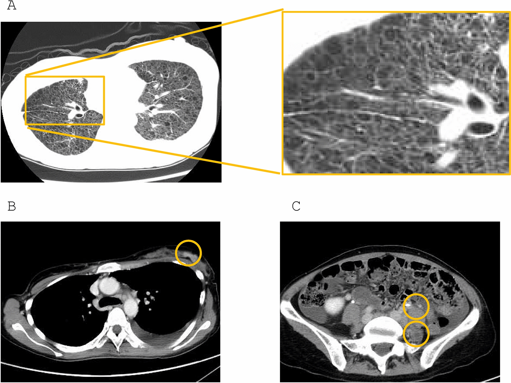 Three cases of whole breast irradiation for breast cancer in patients with Lymphangioleiomyomatosis (LAM)