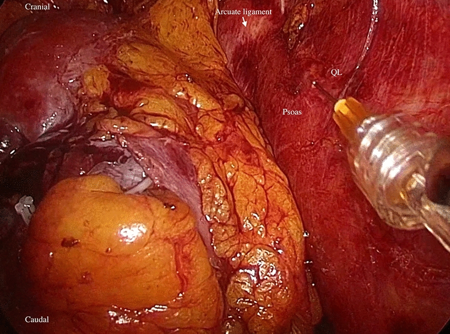 Analgesic Effect of Laparoscopic Versus Ultrasound-Guided Quadratus Lumborum Block in Patients Undergoing Laparoscopic Nephrectomy: A Randomized Controlled Clinical Trial