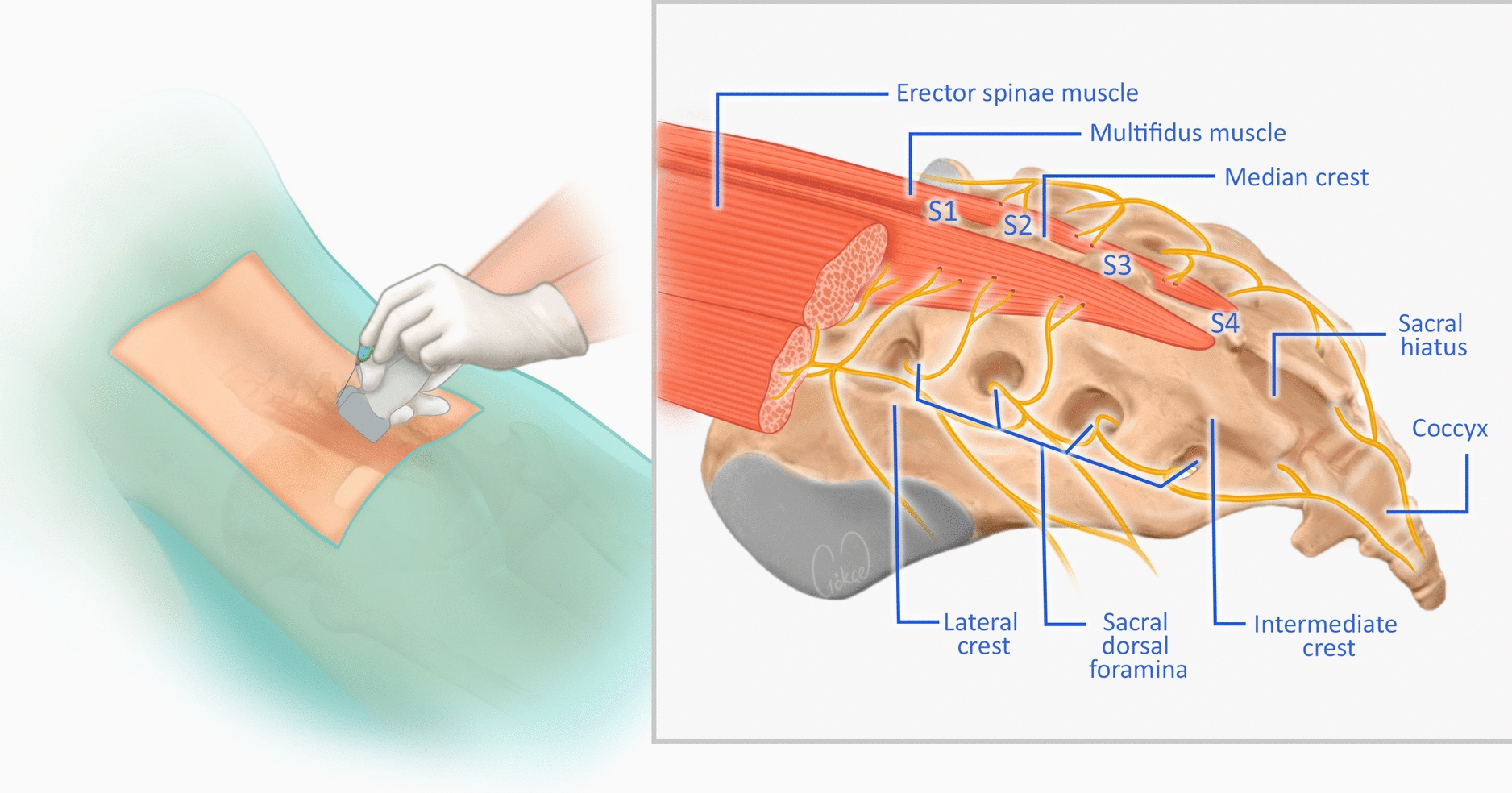 The Sacral Erector Spinae Plane Block: A Narrative Review
