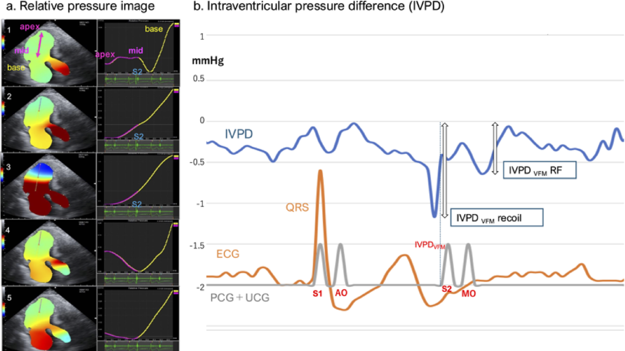 Late-systolic to early-diastolic hemodynamic force analysis in ischemic heart disease using vector flow mapping and invasive pressure measurement