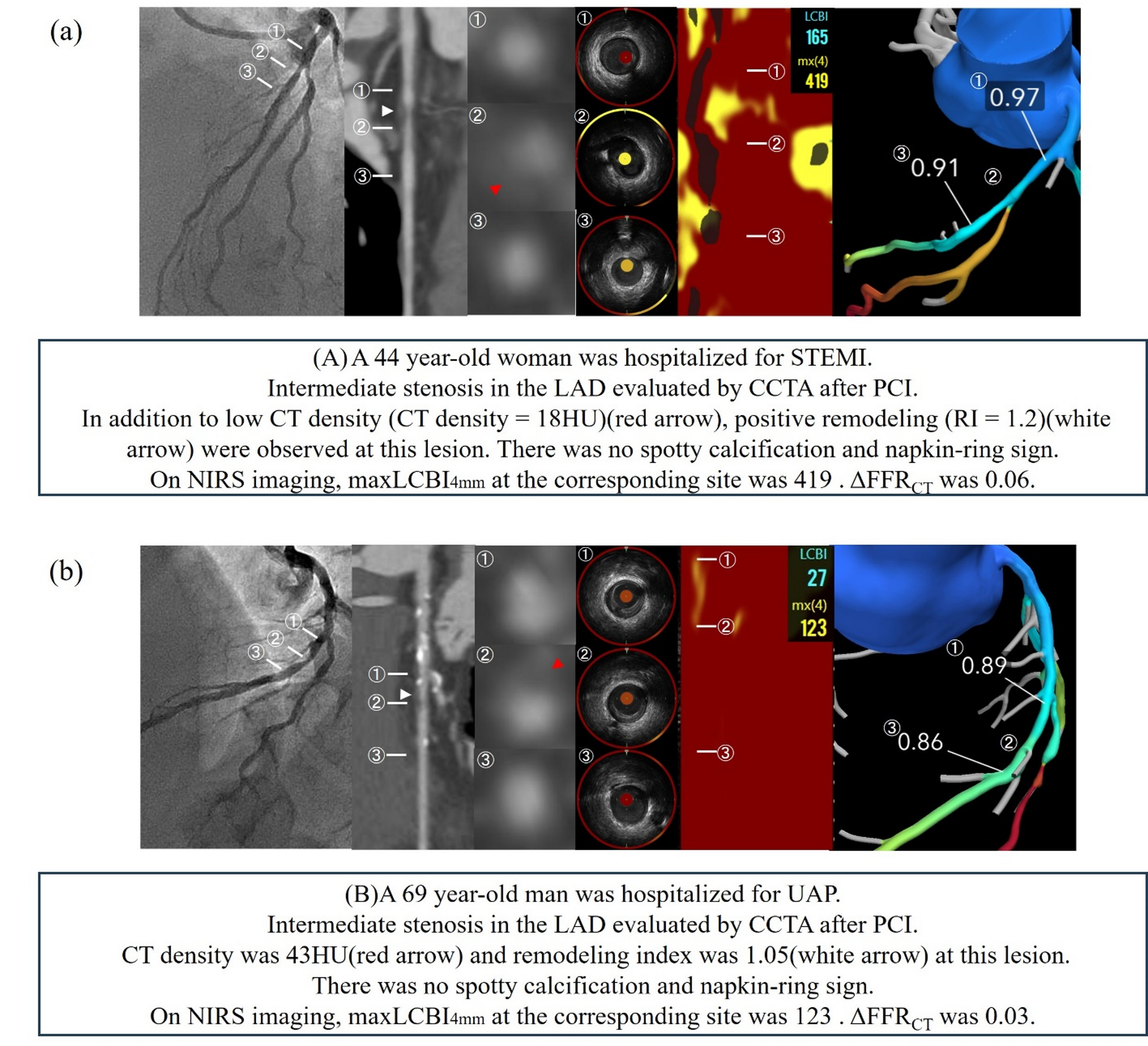 Non-invasive identification of high-risk plaques in non-culprit lesions of acute coronary syndrome