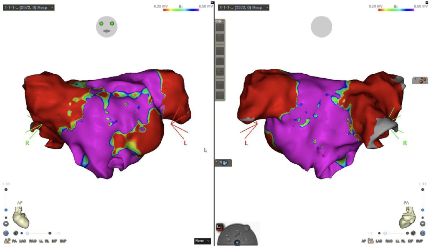 High-frequency low-tidal-volume ventilation during catheter ablation: importance of monitoring electroanatomical mapping system
