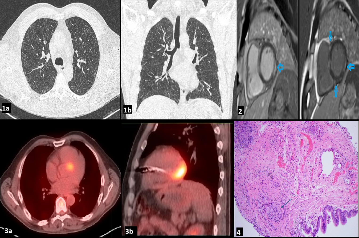 The double threat: imaging manifestations of thoracic sarcoidosis with miliary nodules and myocardial involvement with radiologic-pathologic correlation