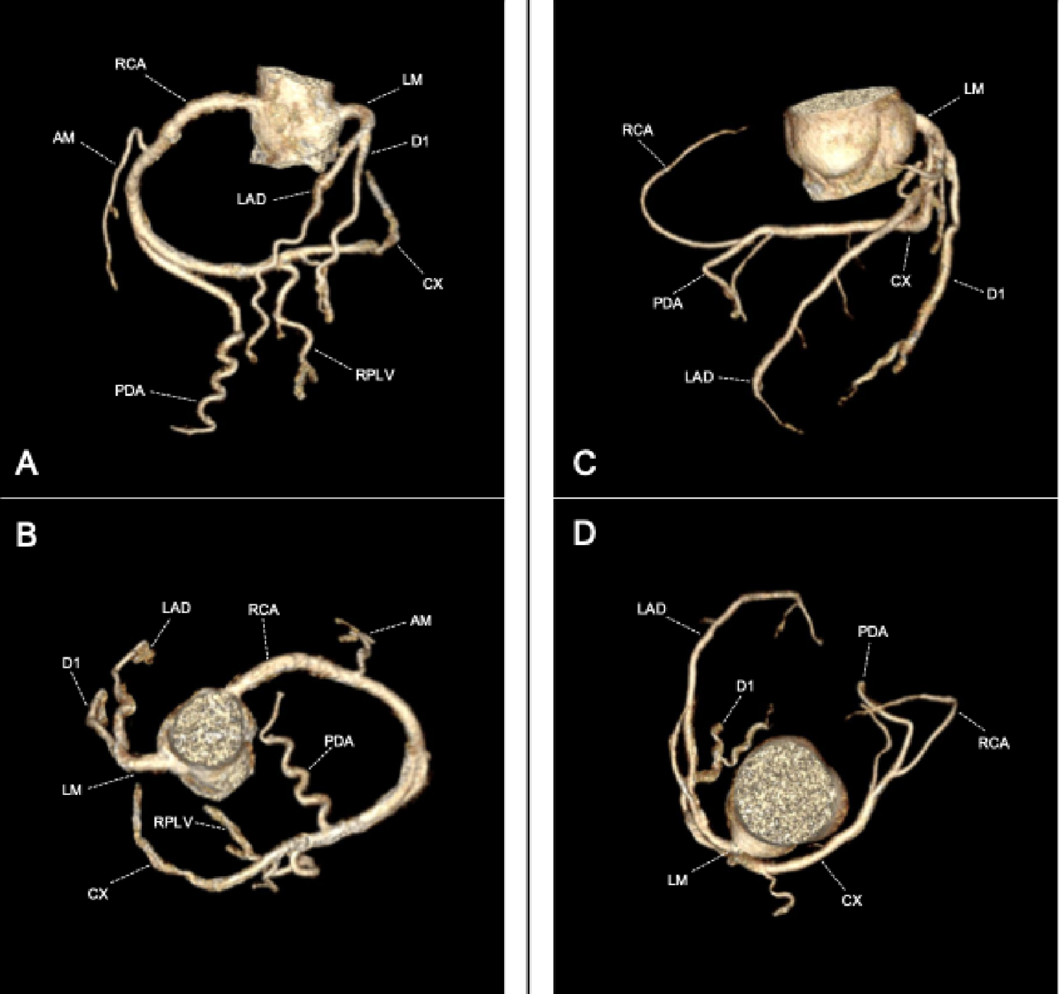 Two coronary tails, one tale: mirror-image distal origin anomalies