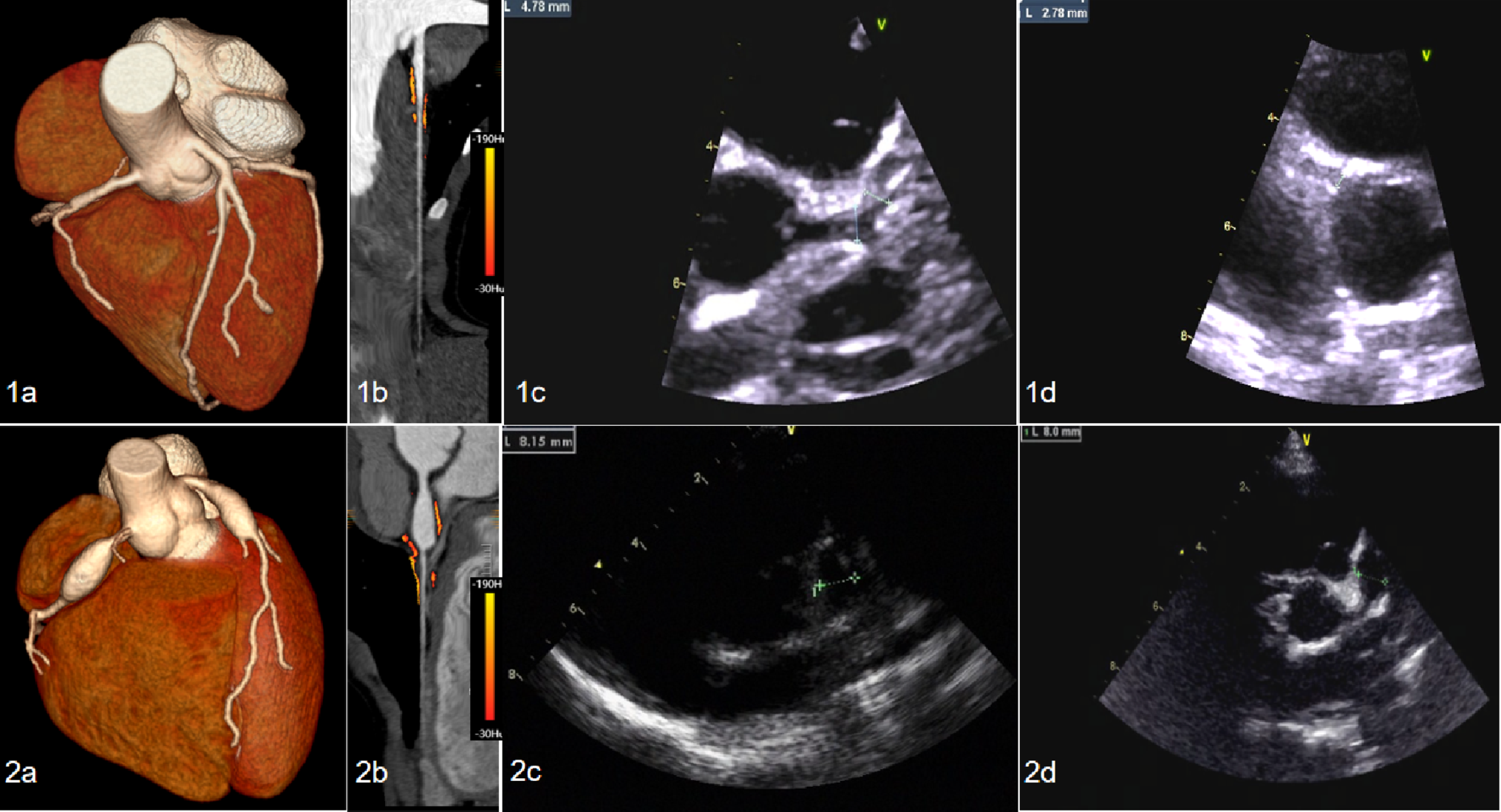‌Coronary inflammatory imaging and clinical factors: associations with coronary artery aneurysm regression in pediatric Kawasaki disease