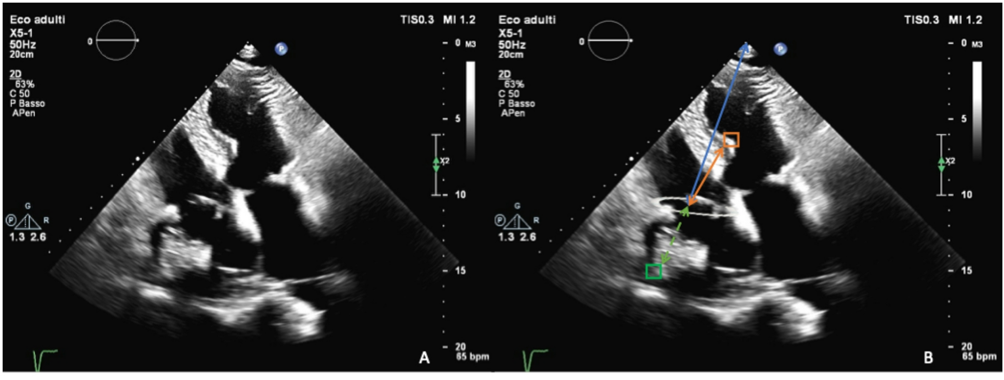Mirror artifact mimicking a large atrial mass
