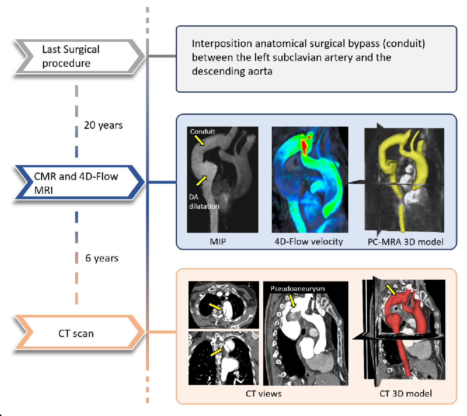 Numerical simulations to predict complication after coarctation repair starting from 4D-Flow magnetic resonance imaging