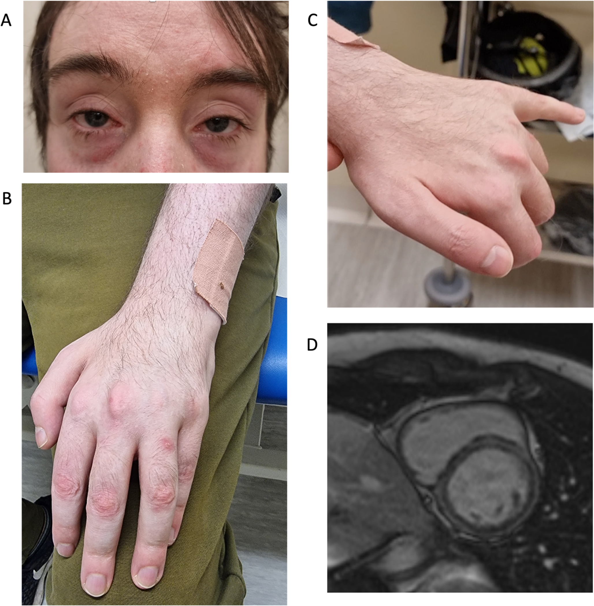 Adult-onset -related congenital myasthenic syndrome-myopathy overlap with upper limb predominant weakness