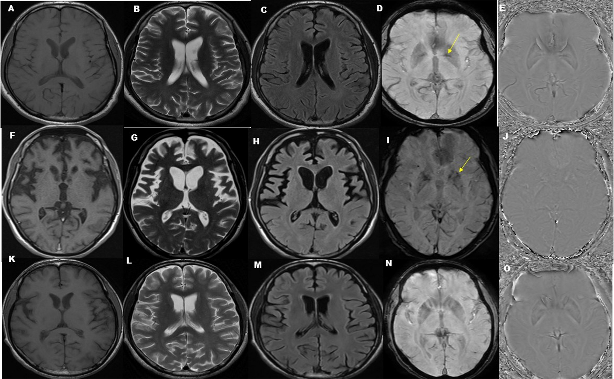 Associated Neurodegeneration (PLAN): similar variant, divergent phenotype